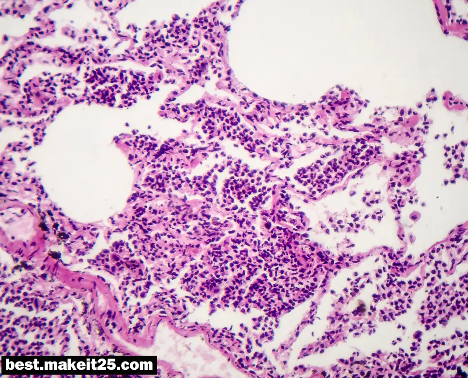 의학용어 UIP, UDS, UVJ, UCL