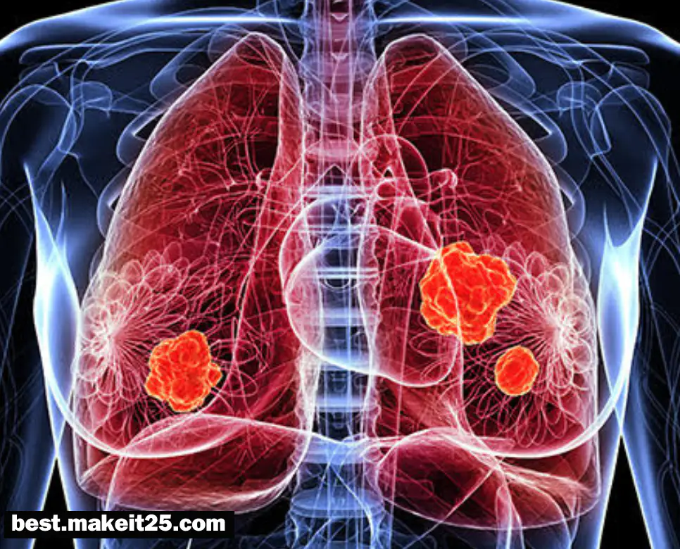 폐암 원인/폐암 초기 증상/ 폐암에 좋은 음식