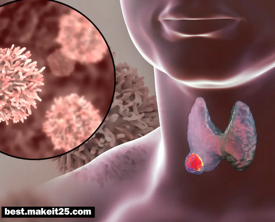 갑상선암 원인/갑상선암 초기 증상/갑상선암에 좋은 음식
